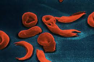anemia falciforma